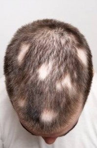 Baldness Can Be Treated With Platelet Rich Plasma